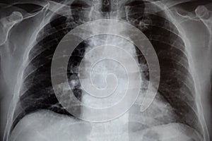 Chest X-ray