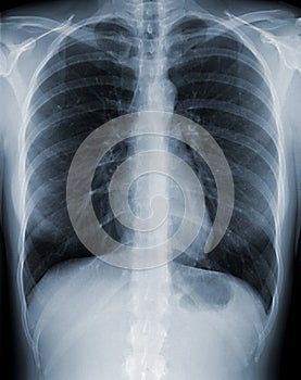 Chest X-Ray