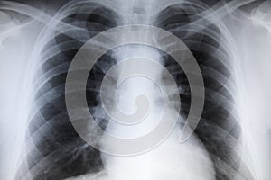 Chest x-ray