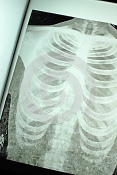 Chest X-Ray