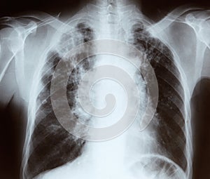 Chest x-ray