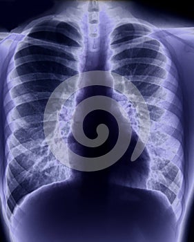 Chest x-ray