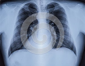 Chest X-ray