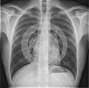 Chest X-ray