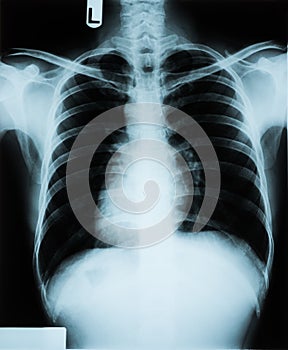 Chest X Ray