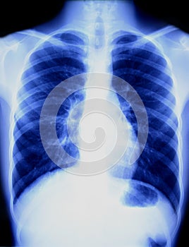 Chest X-ray