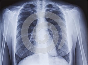 Chest x-ray