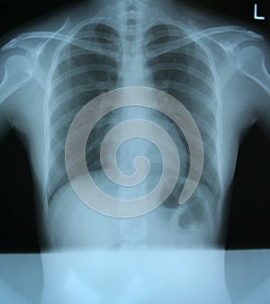 Chest x-ray