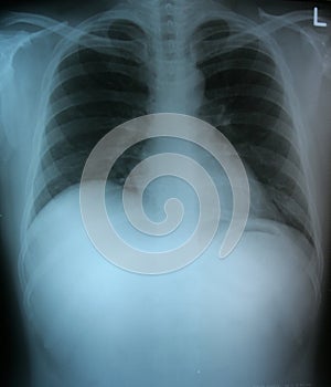 Chest x-ray