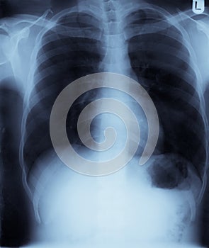 Chest x-ray