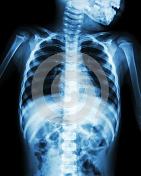 Chest X-ray of child show neck , thorax , shoulder , arm , abdomen