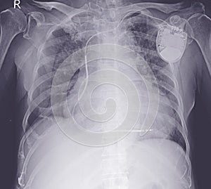 Chest x-ray evere cardiomegaly. Moderate pulmonary congestion