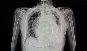 chest x-ray film of a patient with cardiomegaly