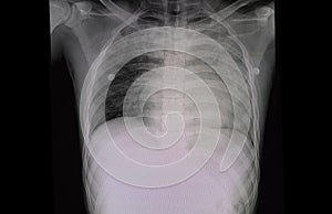 Chest x-ray film of a patient with cardiomegaly and pulmonary edema