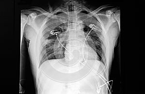 Chest X ray film of a patient with dyspnea