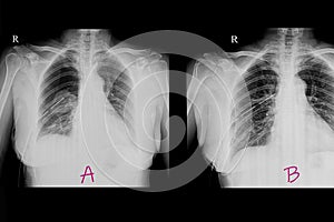 Chest x ray film of a patient with pneumothorax