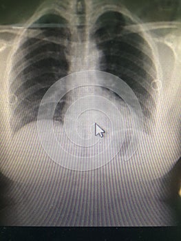 Chest X-ray graphy