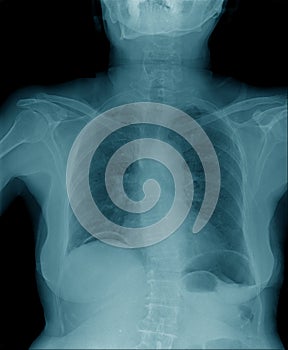 Chest x-ray , hight quality chest x-ray image