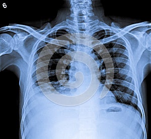 Chest X Ray of human body with right plural effusion.