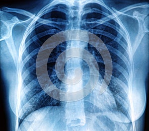 Chest X-ray image