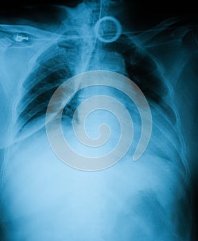 Chest X-ray image, AP view.