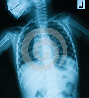 Chest X-ray image, AP view.