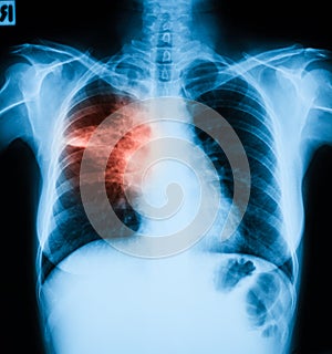 Chest X-ray image, PA upright position.