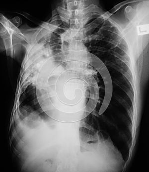 Chest x-ray image, PA upright view.