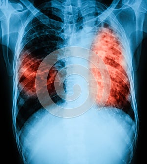 Chest x-ray image of a patient with pulmonary tuberculosis.