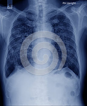 Chest x-ray image with secretion