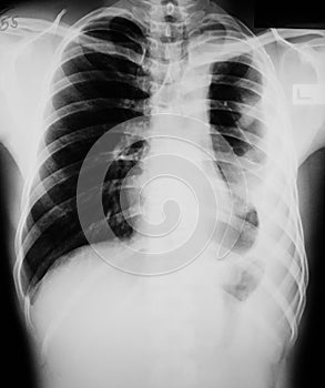 Chest x-ray image showing lung infection.