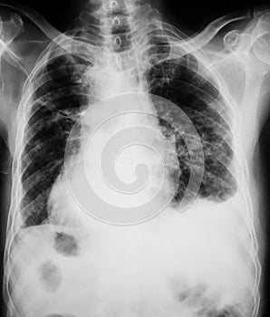 Chest x-ray image showing lung infection.