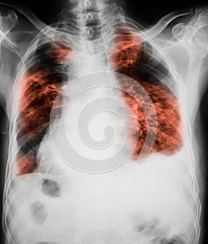 Chest x-ray image showing lungs infection.