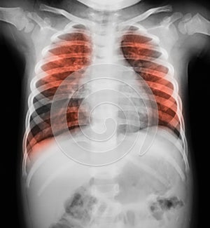 Chest X-ray image of a young boy. Showing lung infection.