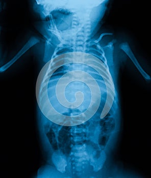 Chest X-ray include abdomen.