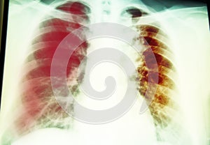 Chest  x-ray for lung infection