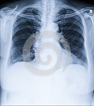 Chest x-ray - lungs, heart, ribs, clavicle. Medicine