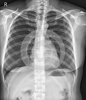 Chest x-ray normal,medical concept.