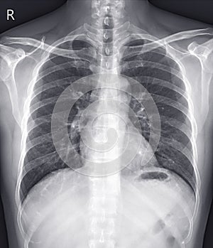 Chest x-ray normal,medical concept.