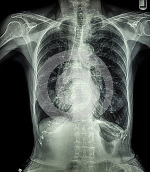 Chest X-ray of old patient ( calcification at rib , trachea , bronchus )