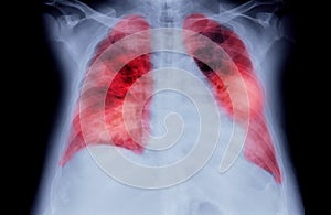 Chest X-ray or X-Ray Image Of Human Chest or Lung ( red zone ) showing tuberculosis
Tuberculosis and corona virus 2019.