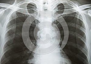 Chest x-ray show alveolar infiltration