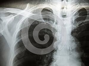 Chest x-ray show alveolar infiltration