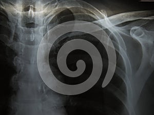 Chest x-ray show alveolar infiltration