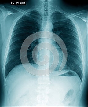 Chest x-ray show inside of lung