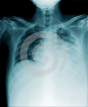 Chest x-ray show many secretion in lower lobe and middle lobe of lung
