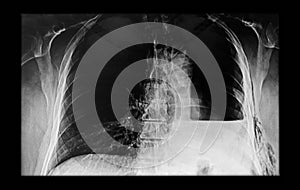 Chest X ray showing a left pneumonectomy and left effusion