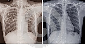 Chest x-ray Showing Normal chest and Pulmonary Tuberculosis TB