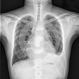 Chest X-ray shows cardiomegaly with infiltration and loculated pleural effusion