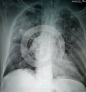 Chest X-Ray of suspected Corona virus patient high quality image showing changes in the lung due to Covid-19 virus with chest tube